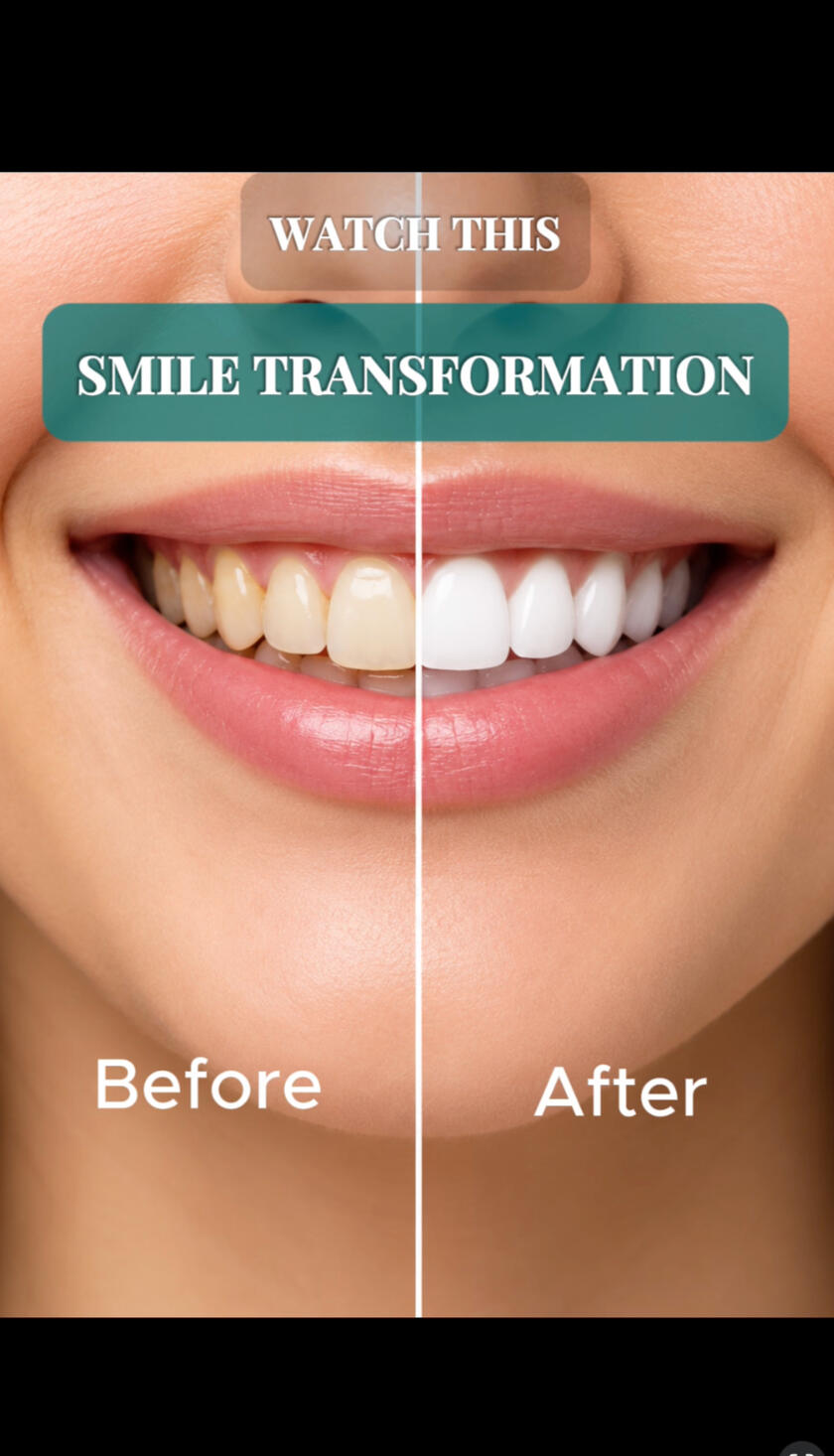 Smile Transformation